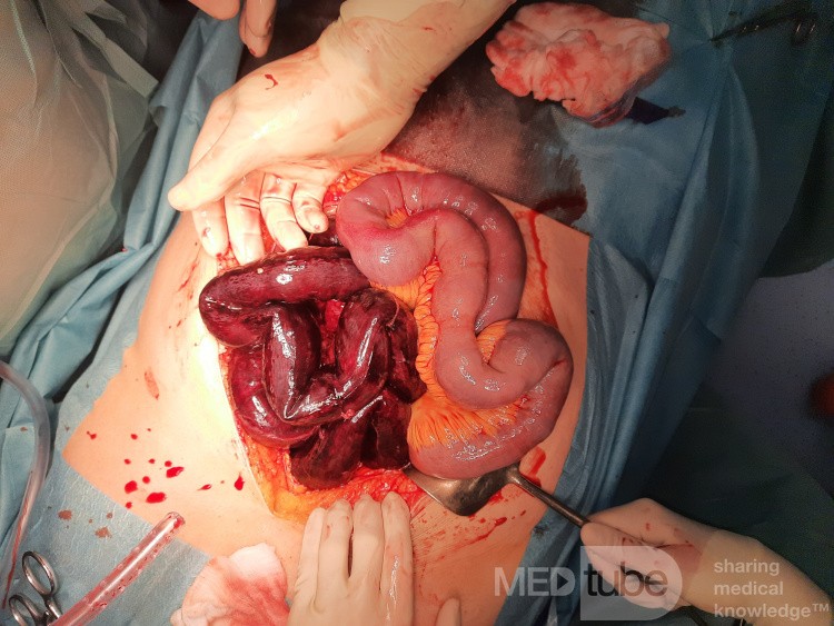 Viszeralvenenthrombose