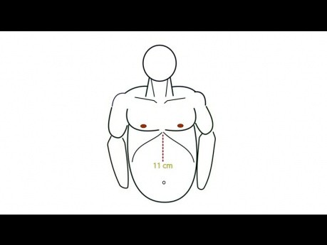 Geometry Fundoplication App Tutorial: Teil 3. Vorbereitung der OP-Saal und Platzierung der Trokare