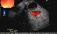 Endoskopische Choledochoduodenostomie