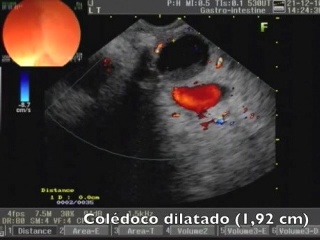 Endoskopische Choledochoduodenostomie