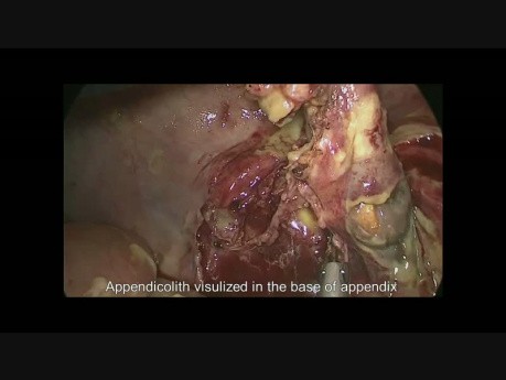 Notfalle Laparoskopische Chirurgie für perforierte Appendizitis