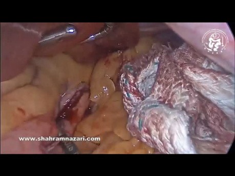 Laparoskopische Schlauchgastrektomie