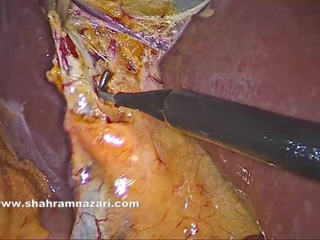 Zystische Vene mit Drainage ins Leberbett bei laparoskopischer Cholezystektomie