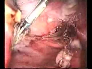 Laparoskopische suprazervikale Hysterektomie