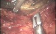 Robotische abdominoperineale Resektion mit distaler Sakrektomie