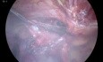 Laparoskopische Operation einer inguinoskrotalen Hernie