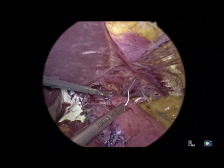 Geometry Fundoplication App Tutorial: Teil 9. Technik der 360º-Fundoplikatio