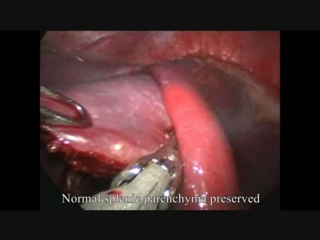 Laparoskopische Milzzcyste Chirurgie