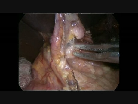 Minimalinvasive Ösophagektomie durch Ivor Lewis Methode