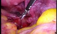 Tiefe Endometriose