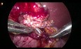 Stent-Einschluss in Nähten