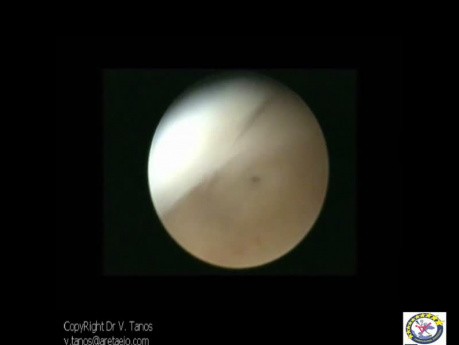 Uterus subseptus