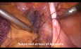 Laparoskopische Appendektomie