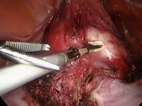 Totale laparoskopische Hysterektomie bei Uterus myomatosus