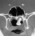 Rhinolith CT-Scan