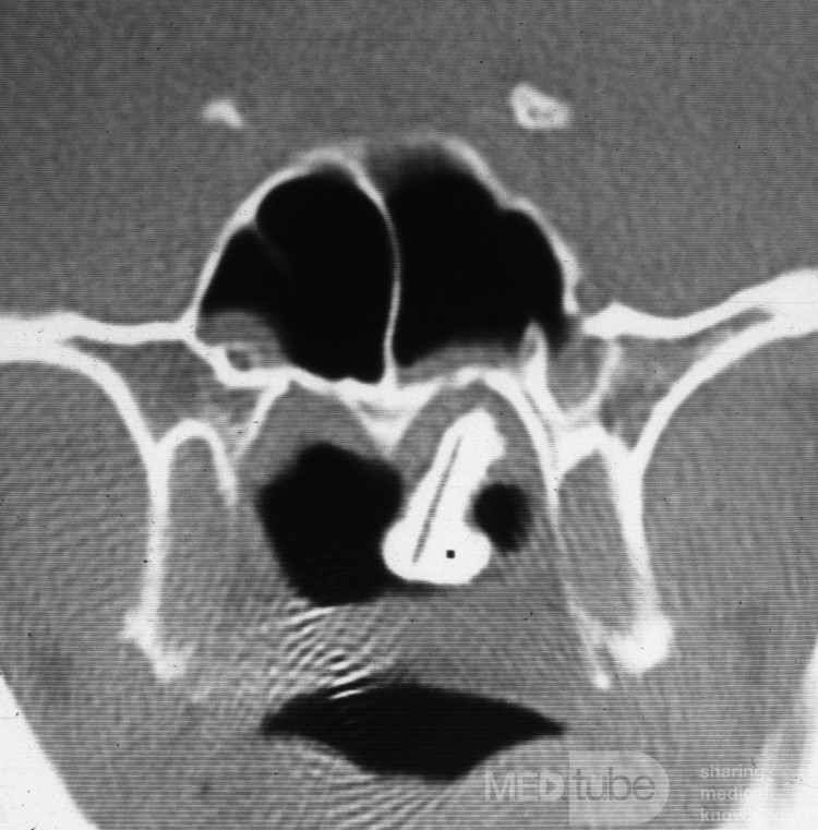 Rhinolith CT-Scan