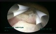 Entfernung des Myoms (4,5cm)- bipolare Resektion