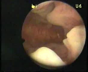 Diagnostische Hysteroskopie zur Diagnostik von der Hyperplasie des Endometriums