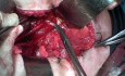 Exzision von Beckenlymphknoten bei Gebärmutterhalskrebs