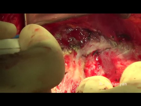 Zytoreduktive Chirurgie des Eierstockkrebses. Das Diaphragma Stripping.