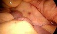 Sigmoidresektion - Laparoskopie