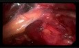 Minilaparoskopie bei der Behandlung einer Lumbalhernie
