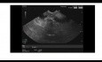 Endosopischer Ultraschall einer frühen Ampullenläsion