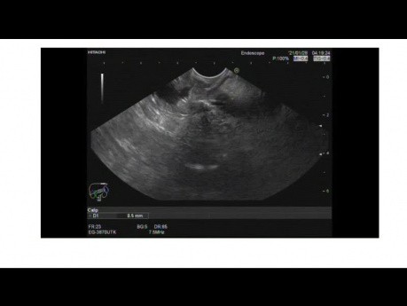 Endosopischer Ultraschall einer frühen Ampullenläsion