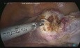 Totale laparoskopische Hysterektomie- Pectopexie (1)