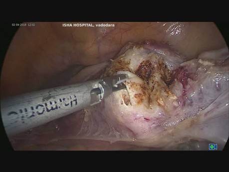 Totale laparoskopische Hysterektomie- Pectopexie (1)