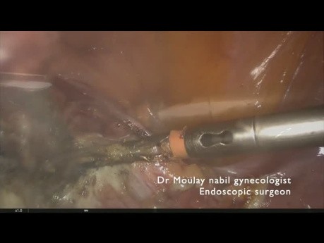 Ambulante totale laparoskopische Hysterektomie mit Ovarialerhaltung