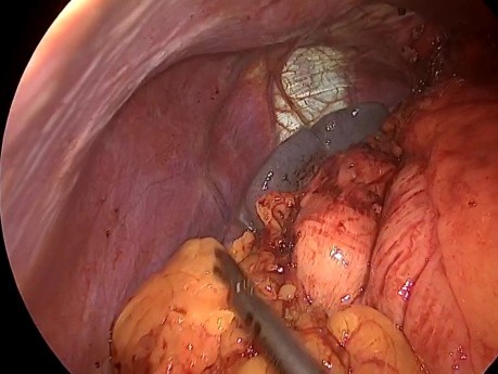 Antirefluxplastik bei einem kompletten Situs inversus Patienten