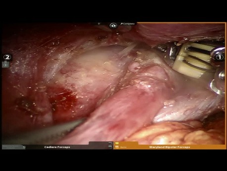 Mediastinales Teratom