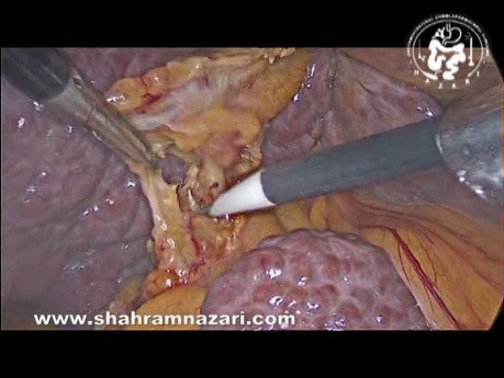 Laparoskopische Cholezystektomie bei zirrhotischen Patienten