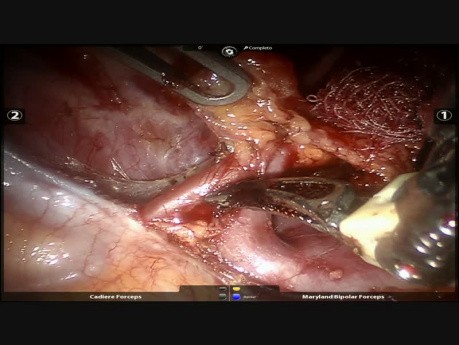 Roboterassistierte Resektion des Mediastinaltumors