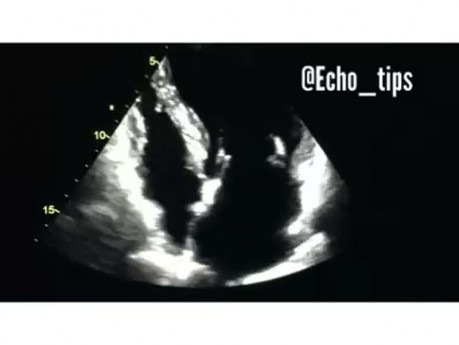 4. Was sehen Sie in der Echokardiographie?