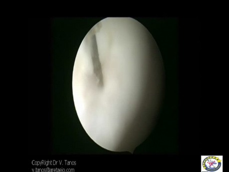 Laparoskopische Ovaroberflächenbehandlung (Drilling)