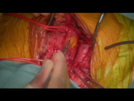 Embolie eines linken Vorhofmyxoms an der Bifurkation der absteigenden abdominalen Aorta
