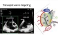Einführung in die 3D-Echokardiographie, Teil 2: Beurteilung von Mitralklappe, Trikuspidalklappe, Aortenklappe, ASD und linkem Vorhofohr