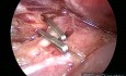 Laparoskopische Cholezystektomie bei einer akuten Pankreatitis nach der Geburt