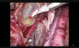 Endometriumkarzinom