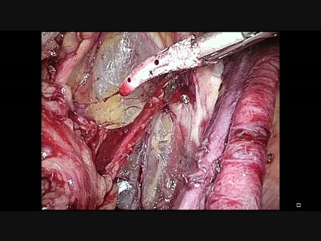 Endometriumkarzinom