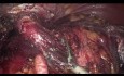 Laparoskopische Gastrektomie nach Magenteilresektion