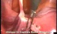 Laparoskopie zur Behandlung der Retroflexio uteri bei deutlichen Beschwerden