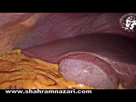 Zusatzzellgewebe der Leber an der Gallenblase