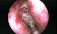 Über den Ursprung der Anwendung des Arthoskop-Shavers in der endoskopischen Nasennebenhöhlenchirurgie (Historisches Video)