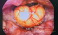 An Epiglottic Inclusion Cyst