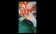 Notfall-Pankreatoduodenektomie bei massiver Magen-Darm-Blutung durch den Ductus Wirsung
