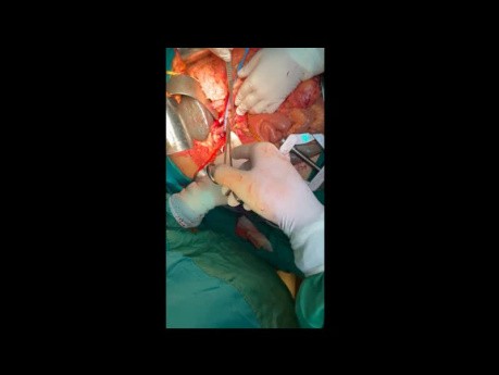 Notfall-Pankreatoduodenektomie bei massiver Magen-Darm-Blutung durch den Ductus Wirsung