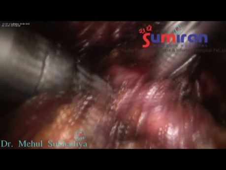 Totale laparoskopische Hysterektomie bei einer Patientin mit einem gefrorenen Becken aufgrund von Endometriose